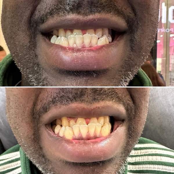 Before and after teeth whitening - real client results