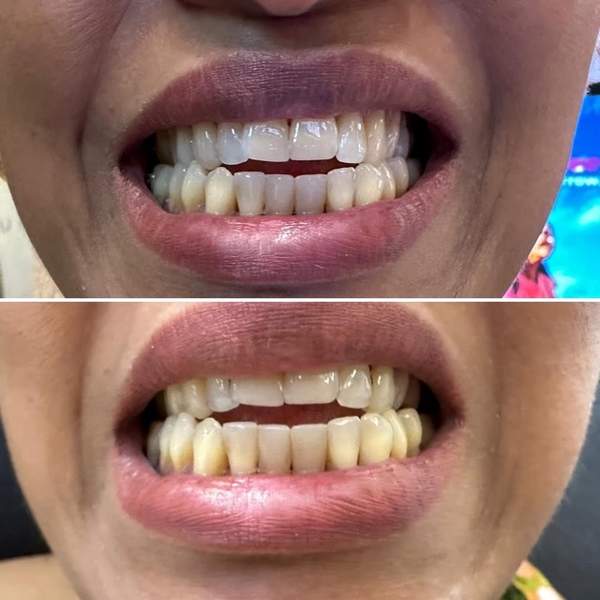 Before and after teeth whitening - real client results